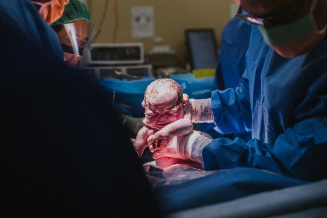 New baby being born by c-section during Perth birth photography session